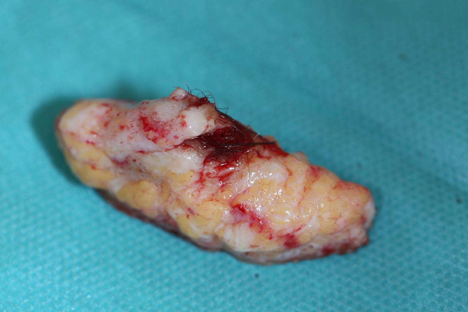 Pièce opératoire — tissu fibro-granulomateux extrait lors de la chirurgie du sinus pilonidal