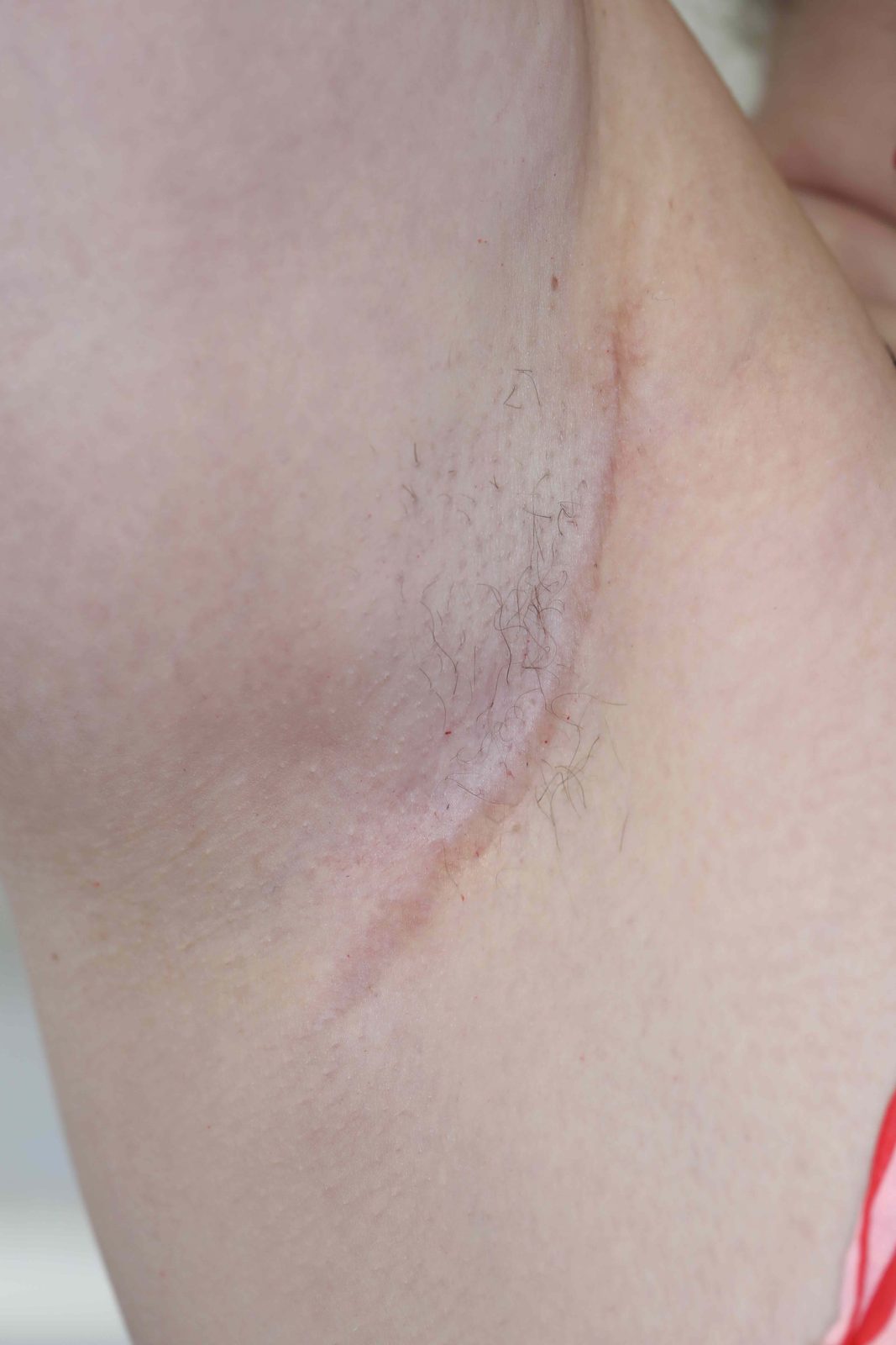 Résultat après exérèse et fermeture par suture