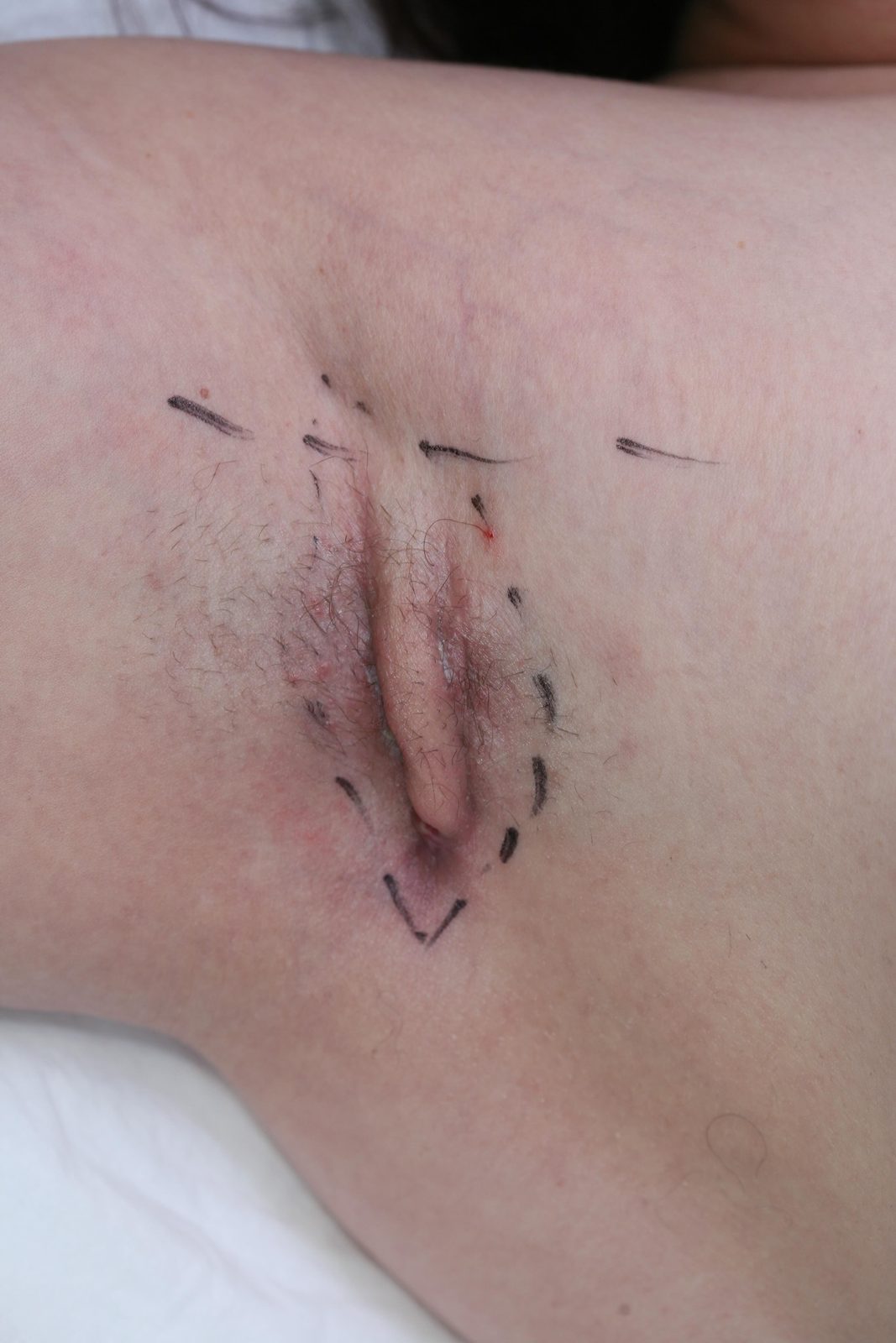 Marquage chirurgical pré-opératoire de la zone d'exérèse